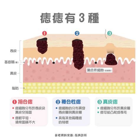 胸部長很多痣|痣形成的原因？痣長毛、痣變多變大是痣病變？5招判別